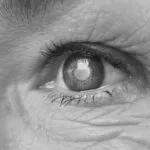 cataract-eye-01